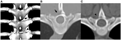 Investigation of canine caudal articular process dysplasia of thoracic vertebrae using computed tomography: Prevalence and characteristics